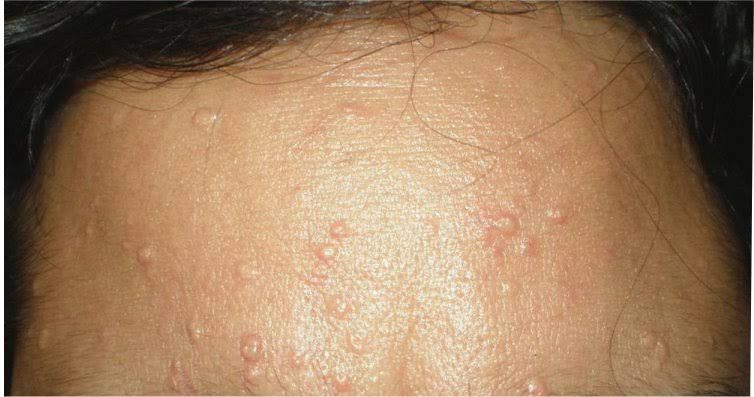 imagem de Hiperplasia Sebácea e Adenoma Sebáceo